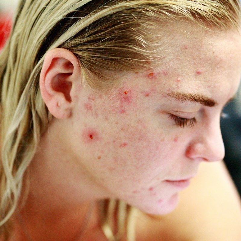 acne piel sensible atópica